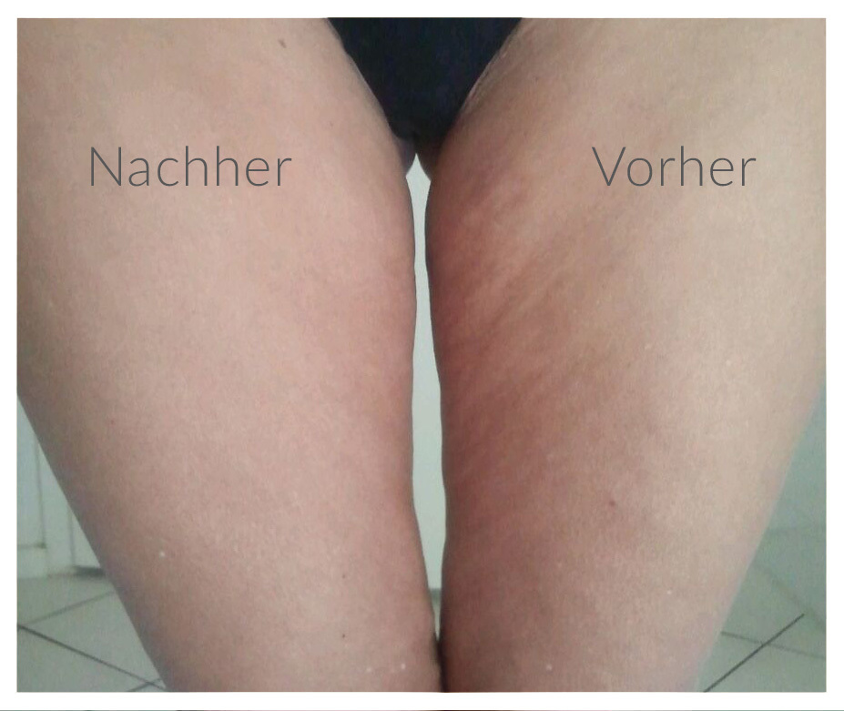 Cellulite-vorher-nachher